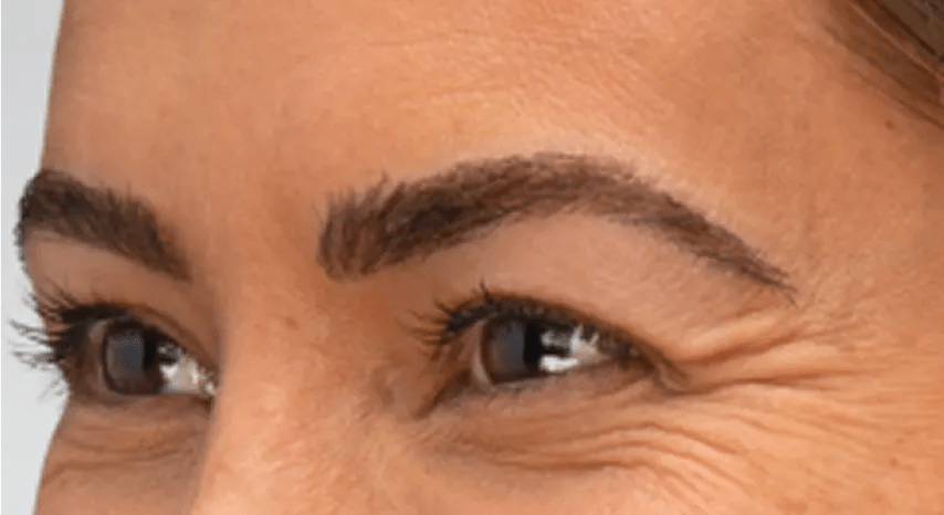 Botox Crow’s Feet