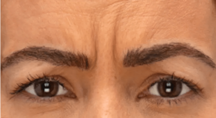 Botox Frown Lines