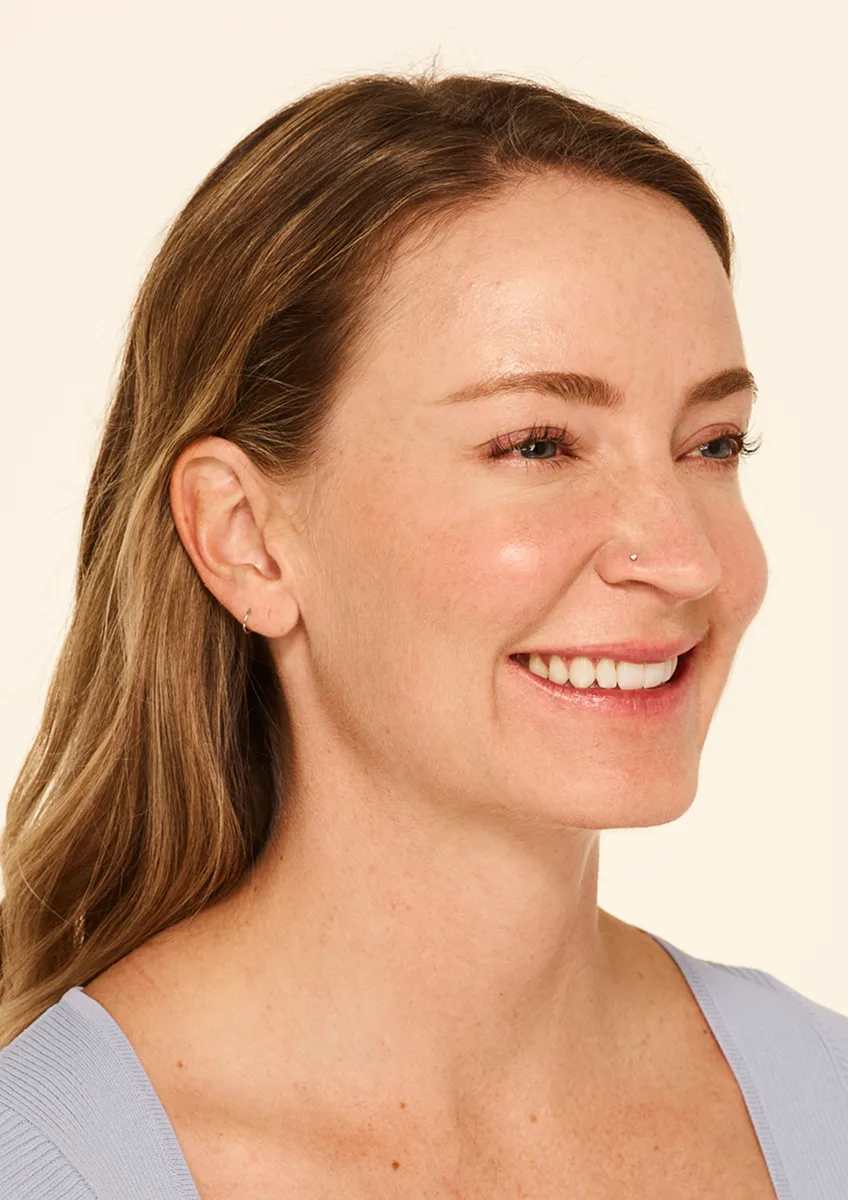 Botox Moderate to Severe Crow’s Feet Lines after - Mandy