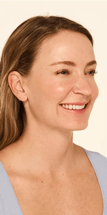 Botox Moderate to Severe Crow’s Feet Lines after - Mandy