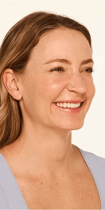 Botox Moderate to Severe Crow’s Feet Lines before - Mandy