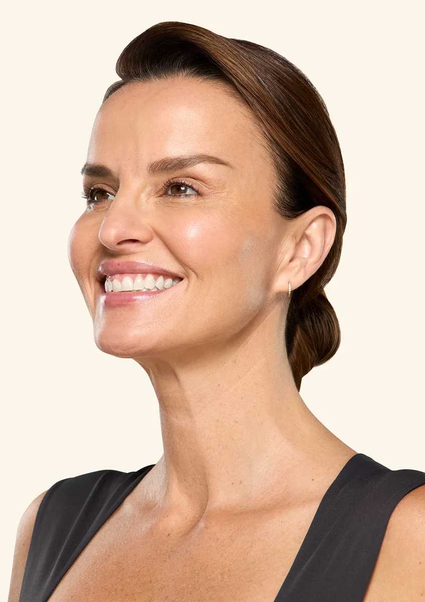 Botox neck and jaw after - Ana
