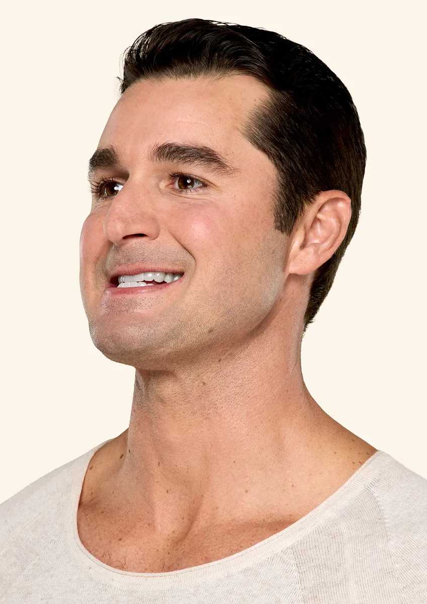 Botox neck and jaw after - Ben