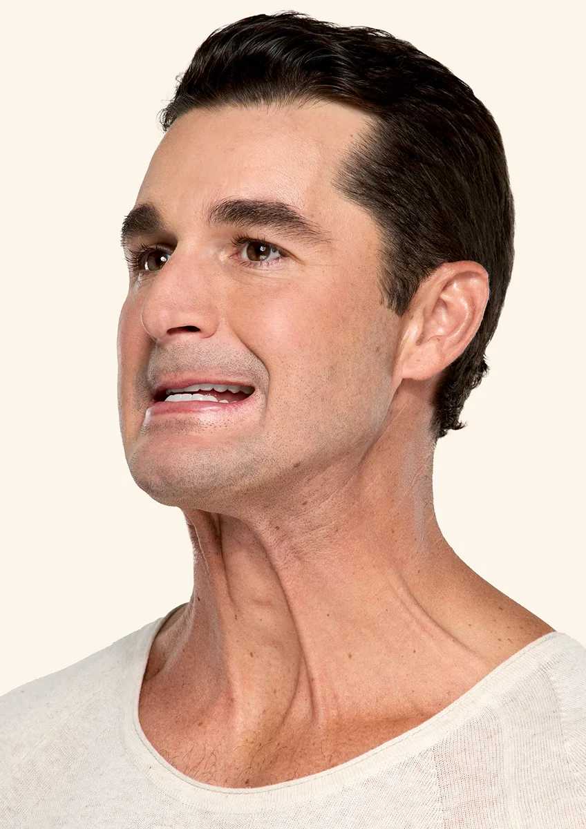 Botox neck and jaw before - Ben