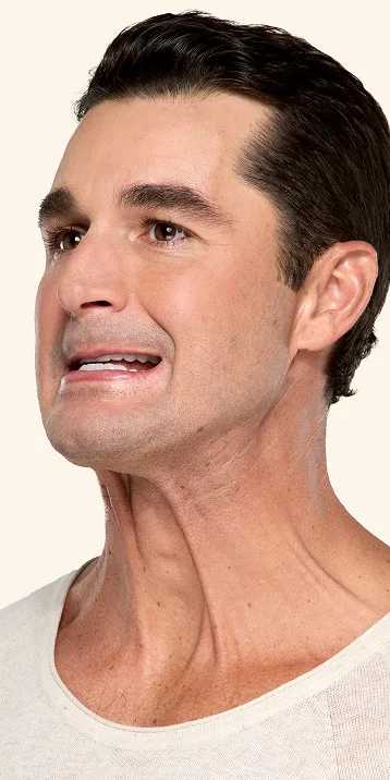 Botox neck and jaw before - Ben