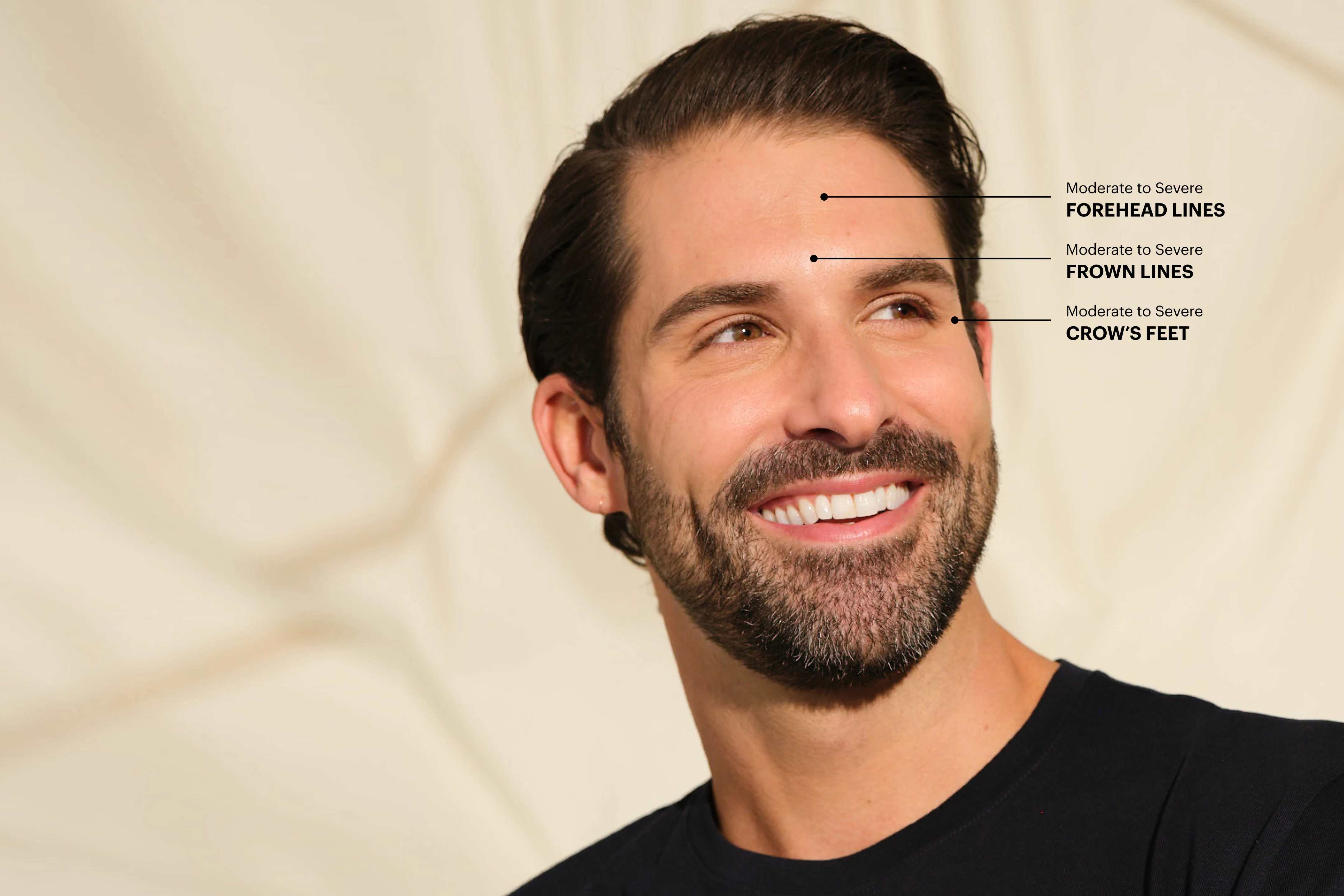 Botox male model with treatment areas