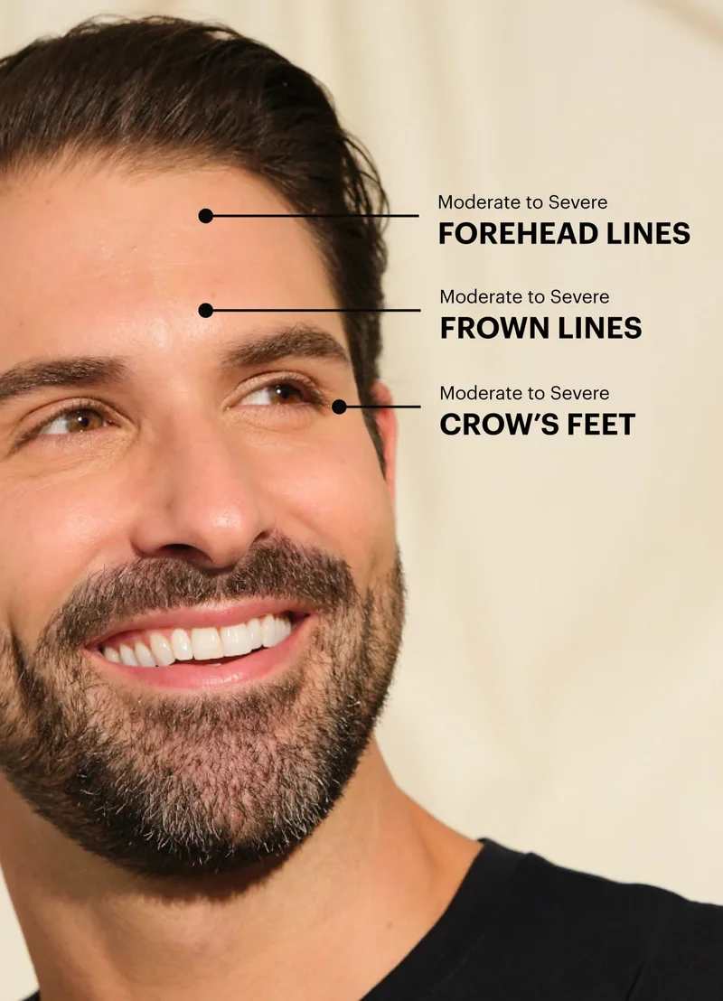 Botox upper facial treatment areas