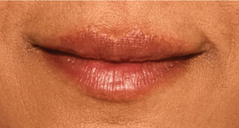 Aashna - After Lip Filler