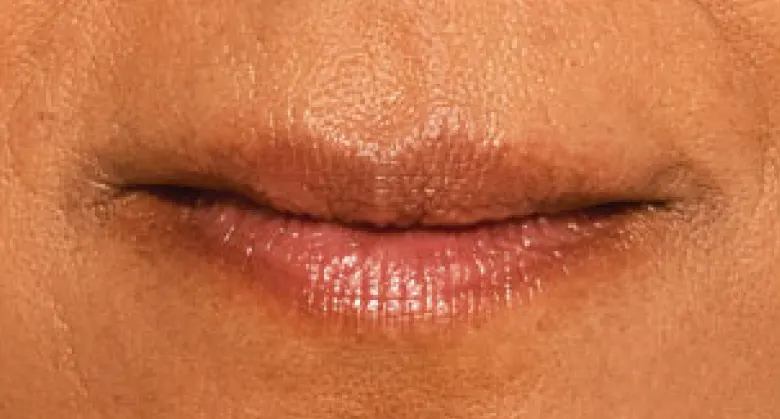 Aashna - Before Lip Filler