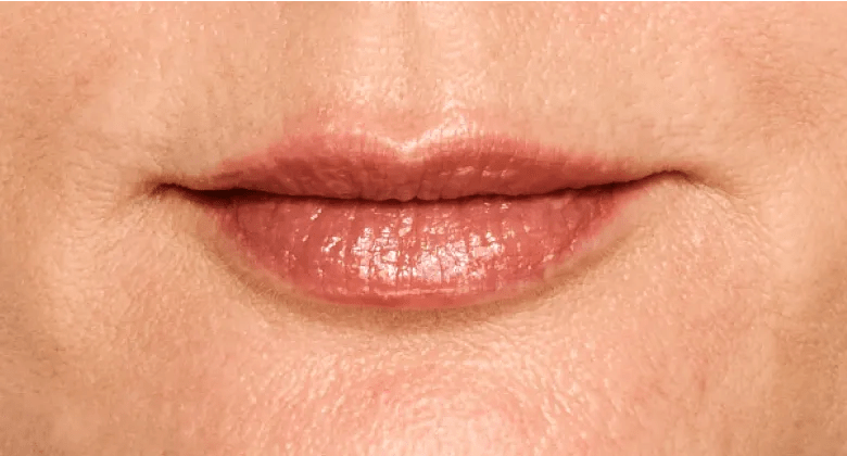 Aleksandra - After Lip Filler
