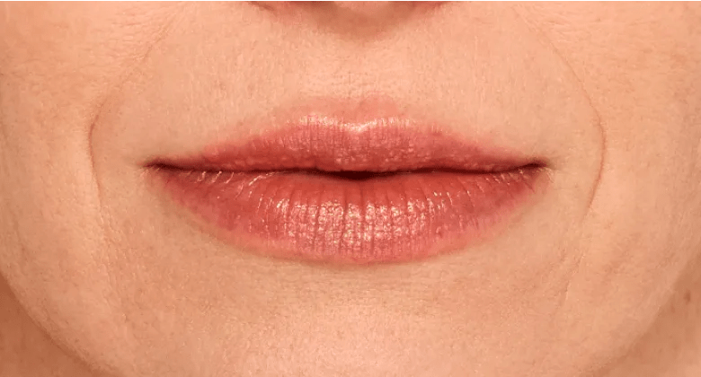 Amanda - After Lip Filler