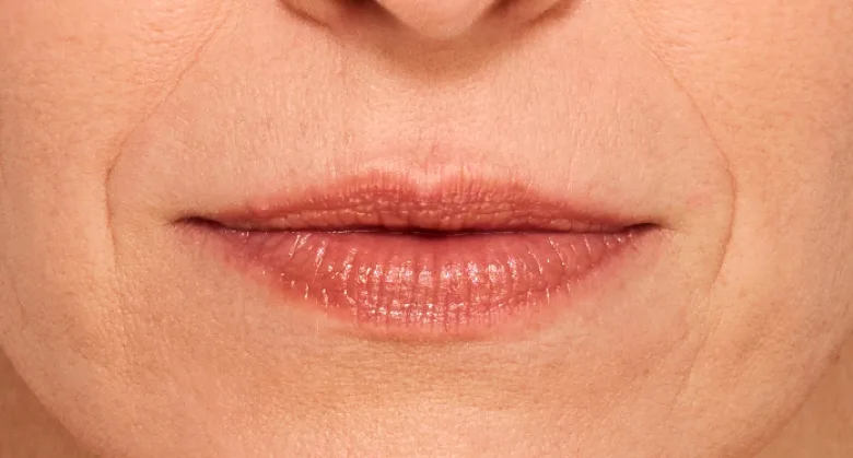 Amanda - Before Lip Filler