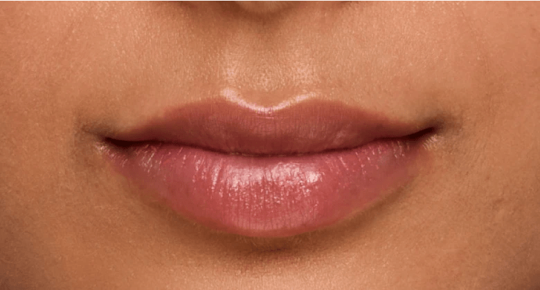 Jaskiran - After Lip Filler