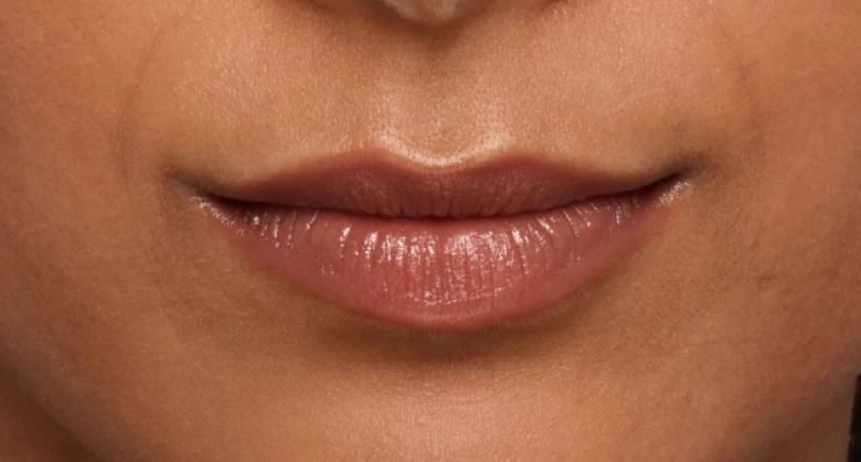 Jaskiran - Before Lip Filler