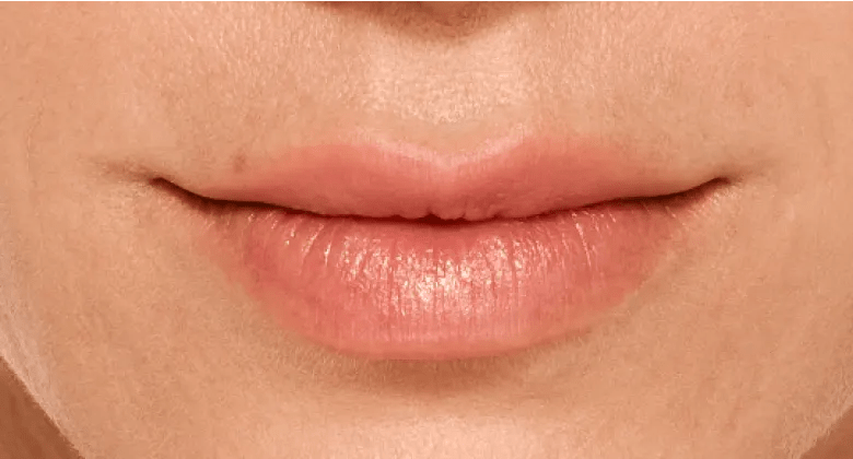 Juliette - After Lip Filler