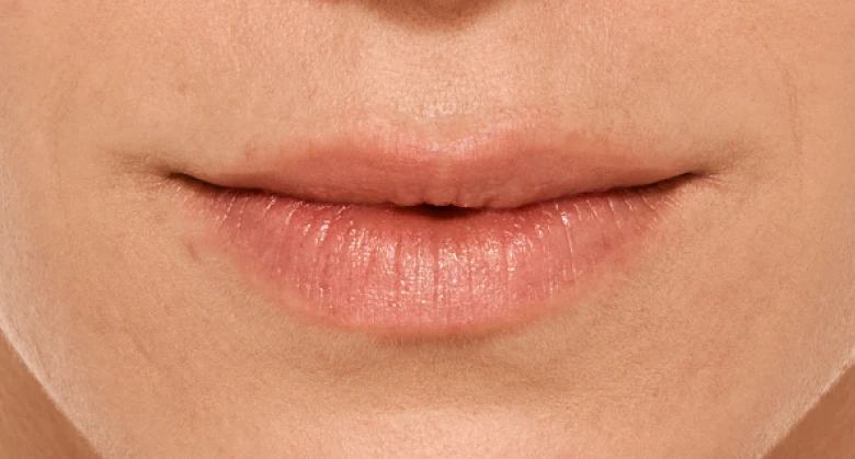 Juliette - Before Lip Filler