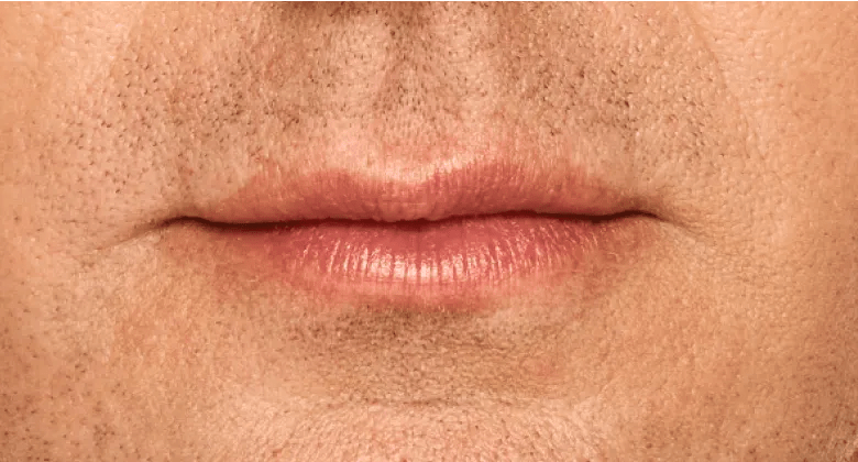 Matt - After Lip Filler