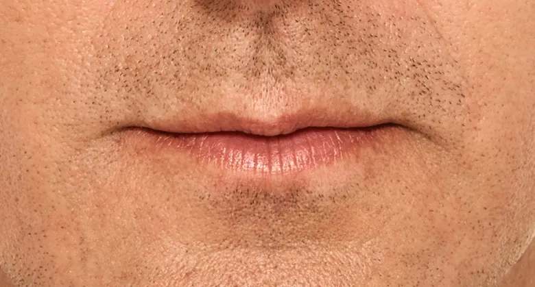 Matt - Before Lip Filler