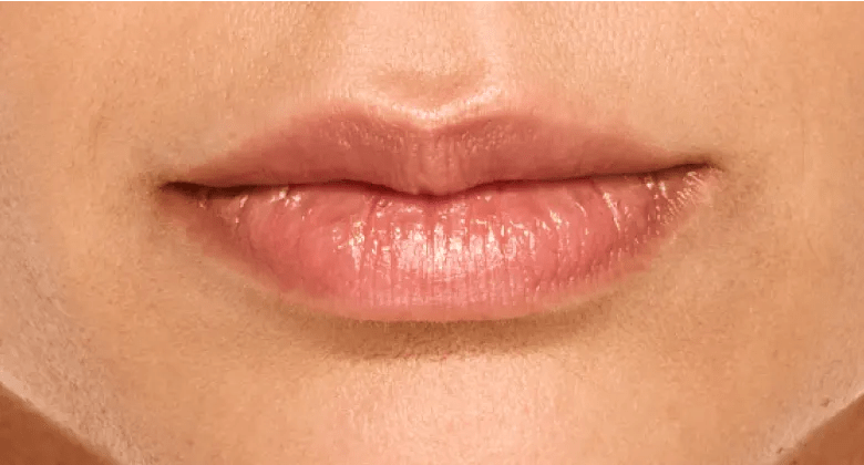 Sthefani - After Lip Filler