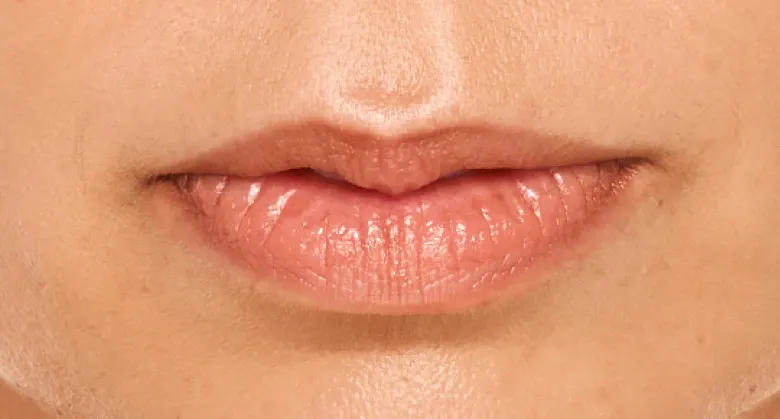 Sthefani - Before Lip Filler