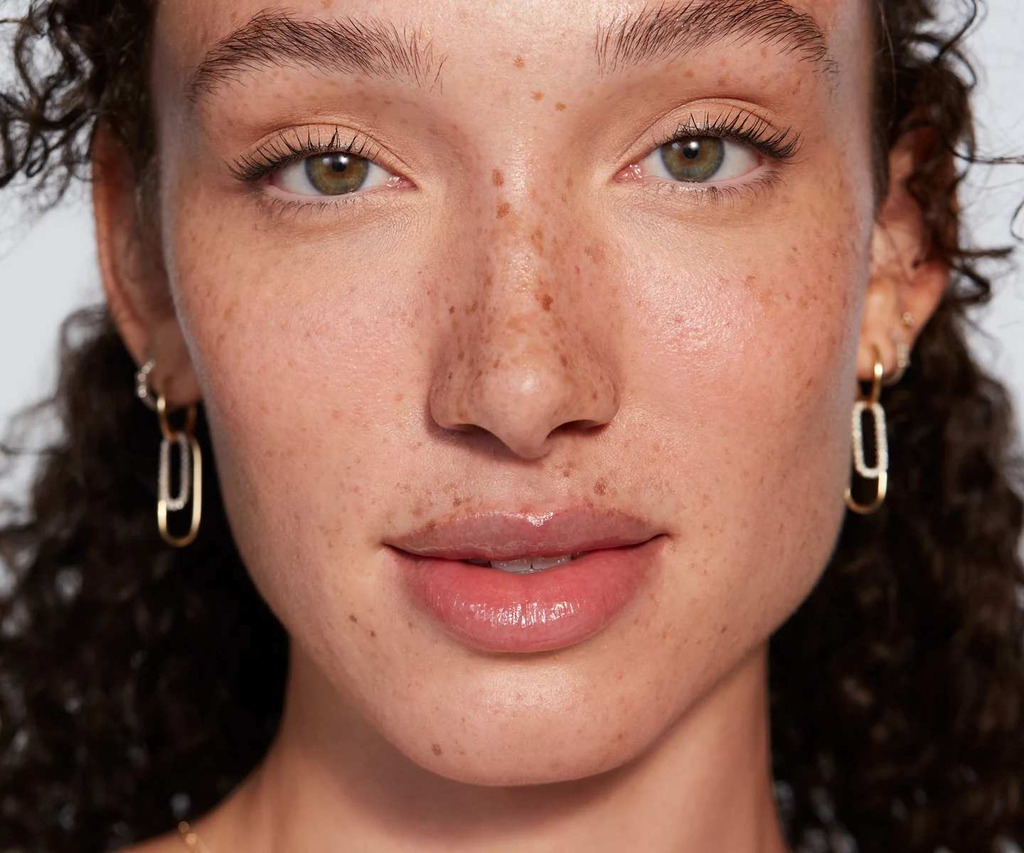 Juvederm model with freckles