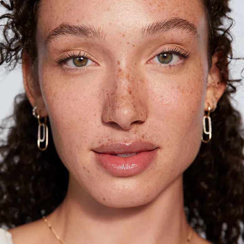 Juvederm model with freckles