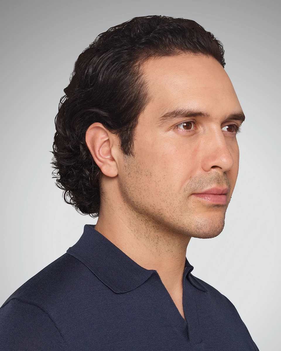 Devin - Jawline Before Juvederm