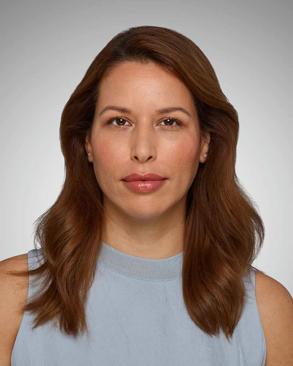 Glenda - Smile Lines After Juvederm