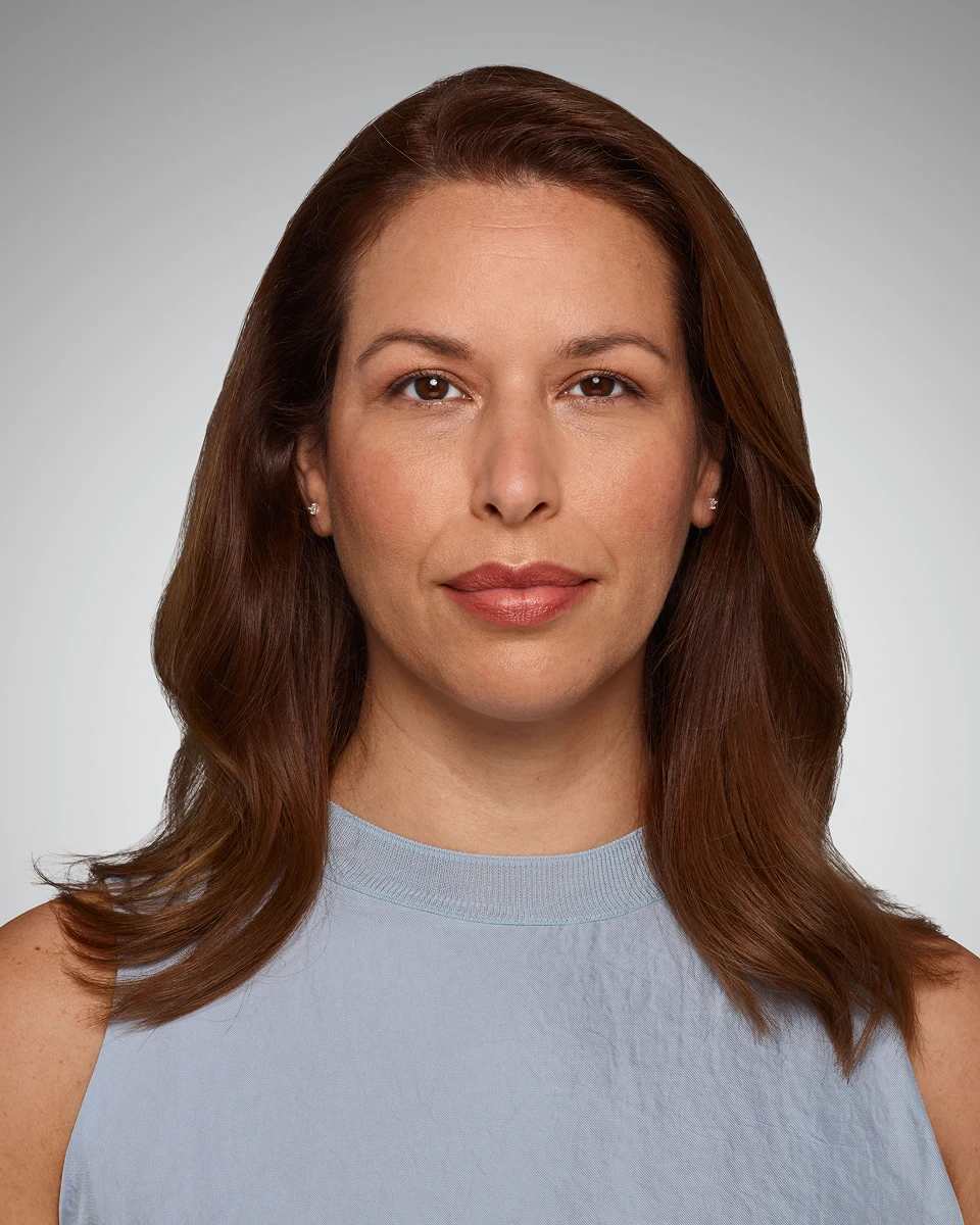 Glenda - Smile Lines Before Juvederm