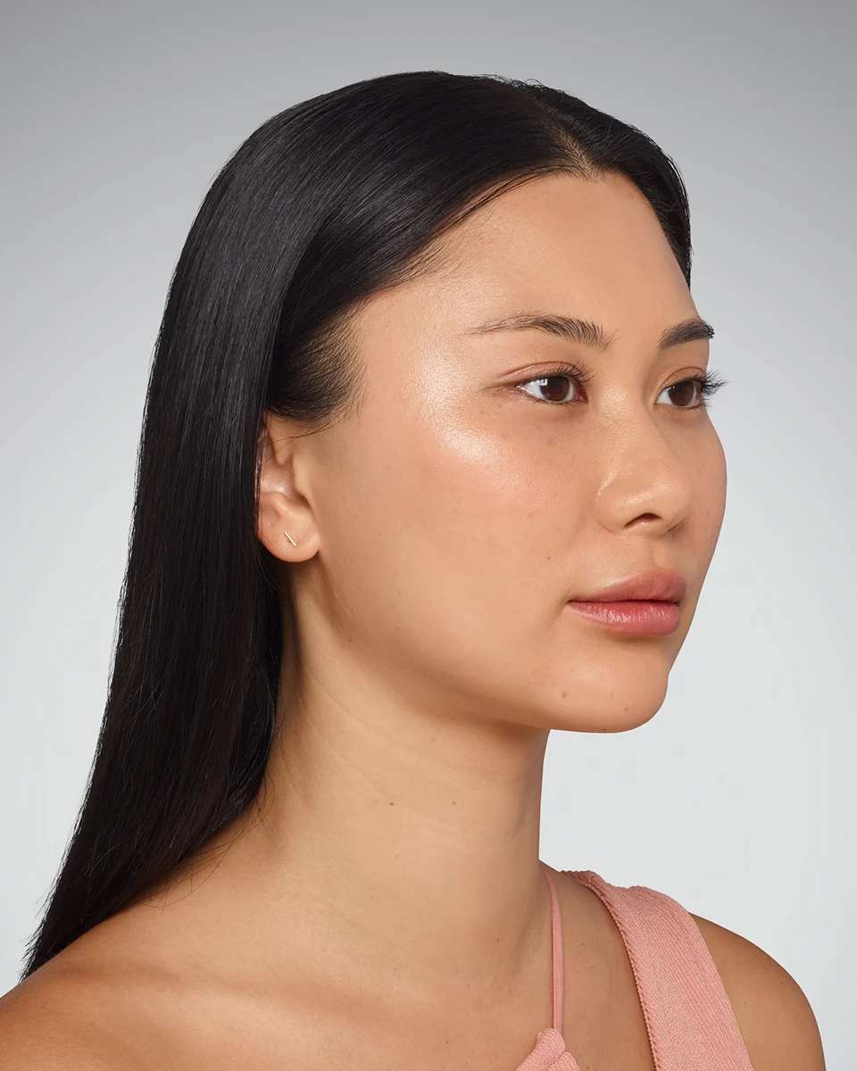Sara - Undereye After Juvederm