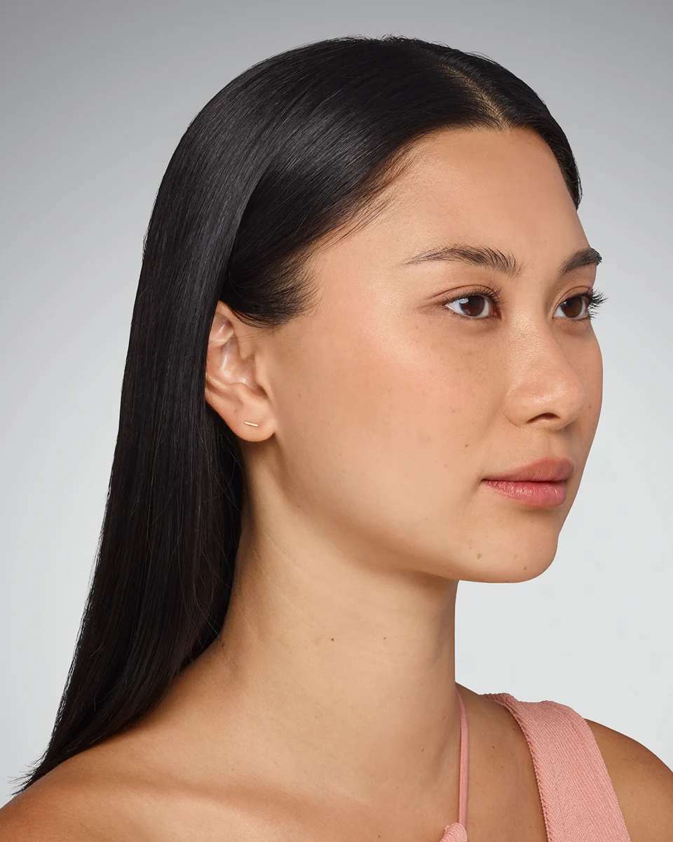 Sara - Undereye Before Juvederm