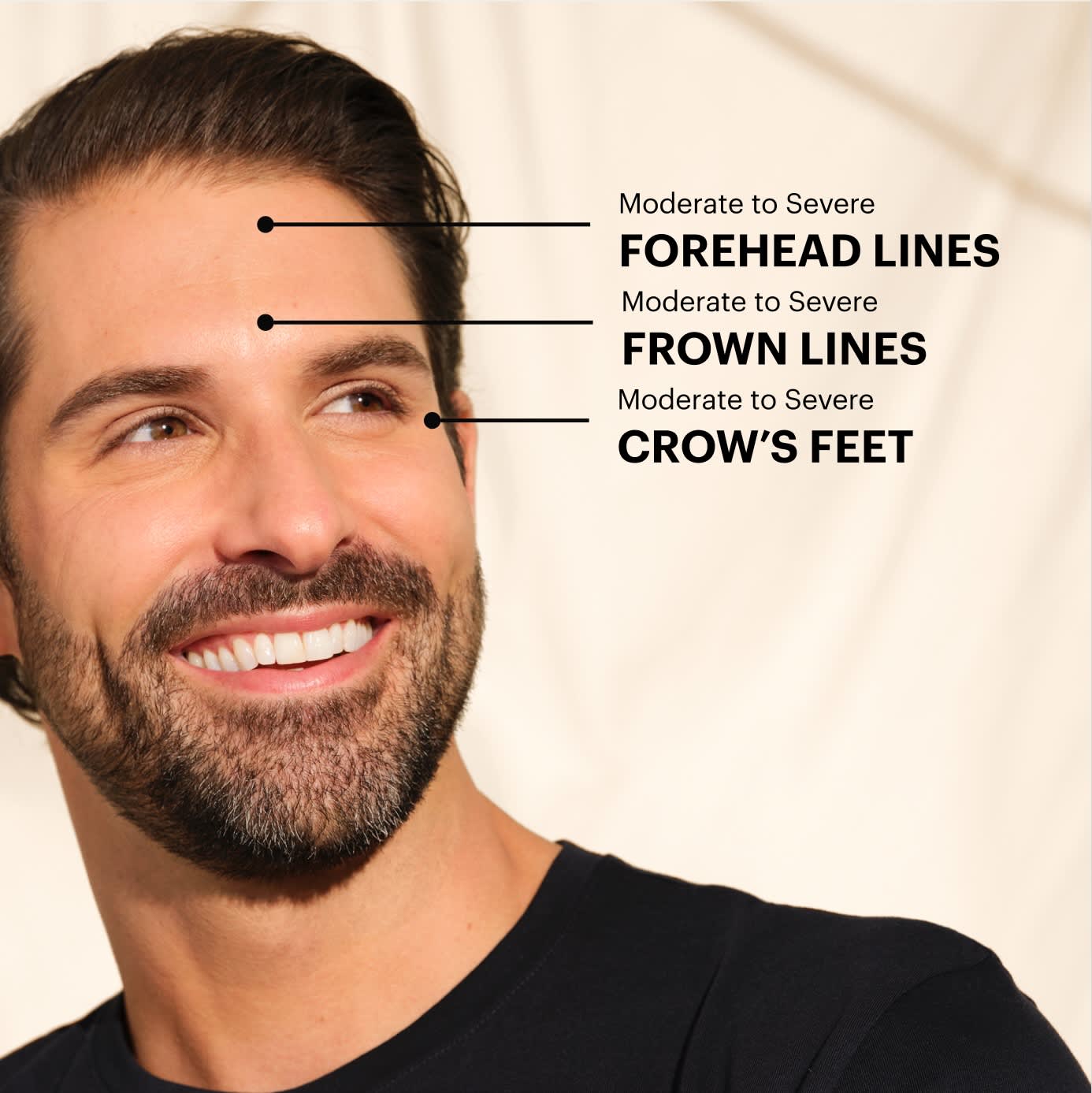 Botox upper facial treatment areas