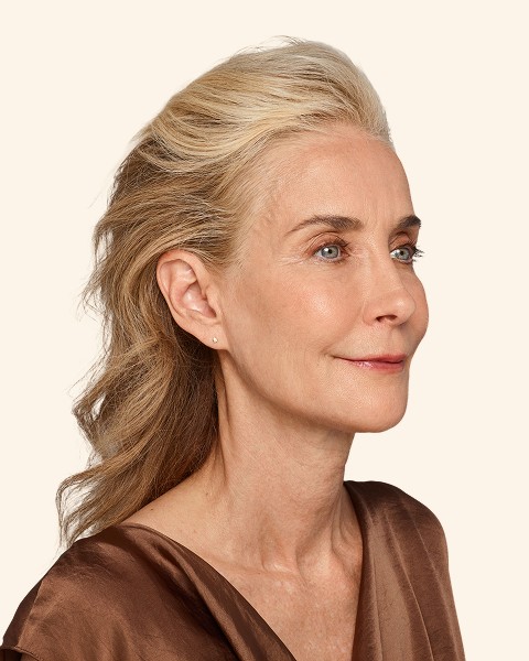 Cheryl - Lips & Smile Lines After Juvederm