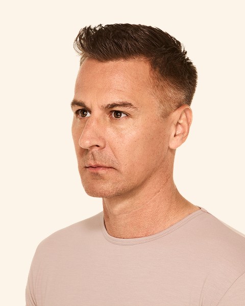 Matt - Jawline Before Juvederm