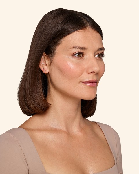 Victoria - Undereye After Juvederm