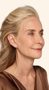 Cheryl - Lips & Smile Lines After Juvederm