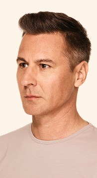 Matt - Jawline After Juvederm