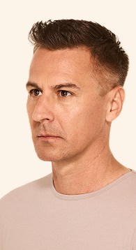 Matt - Jawline Before Juvederm