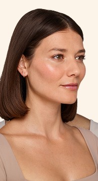 Victoria - Undereye After Juvederm