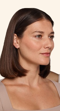 Victoria - Undereye Before Juvederm