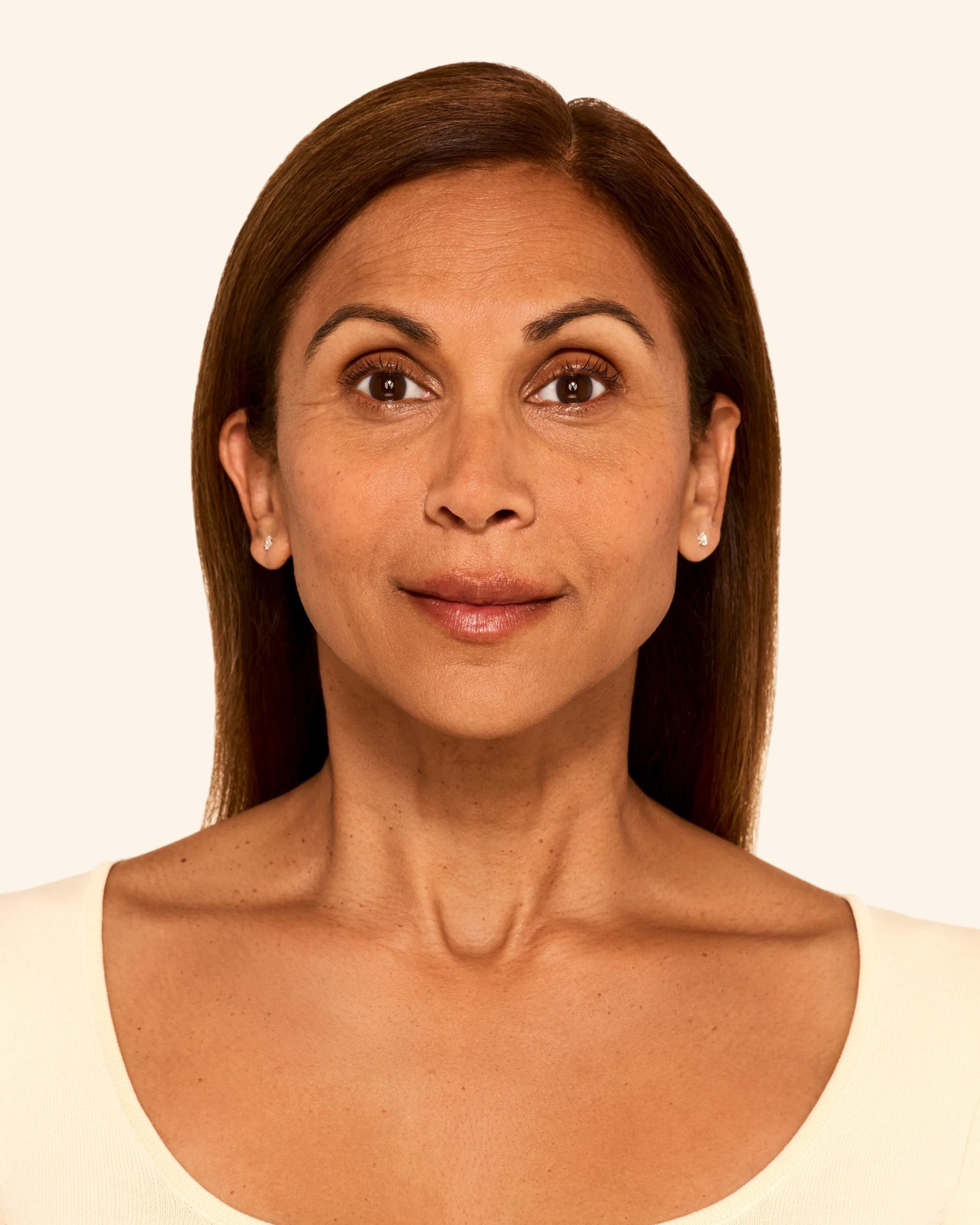 Aashna - Smile Lines After Juvederm