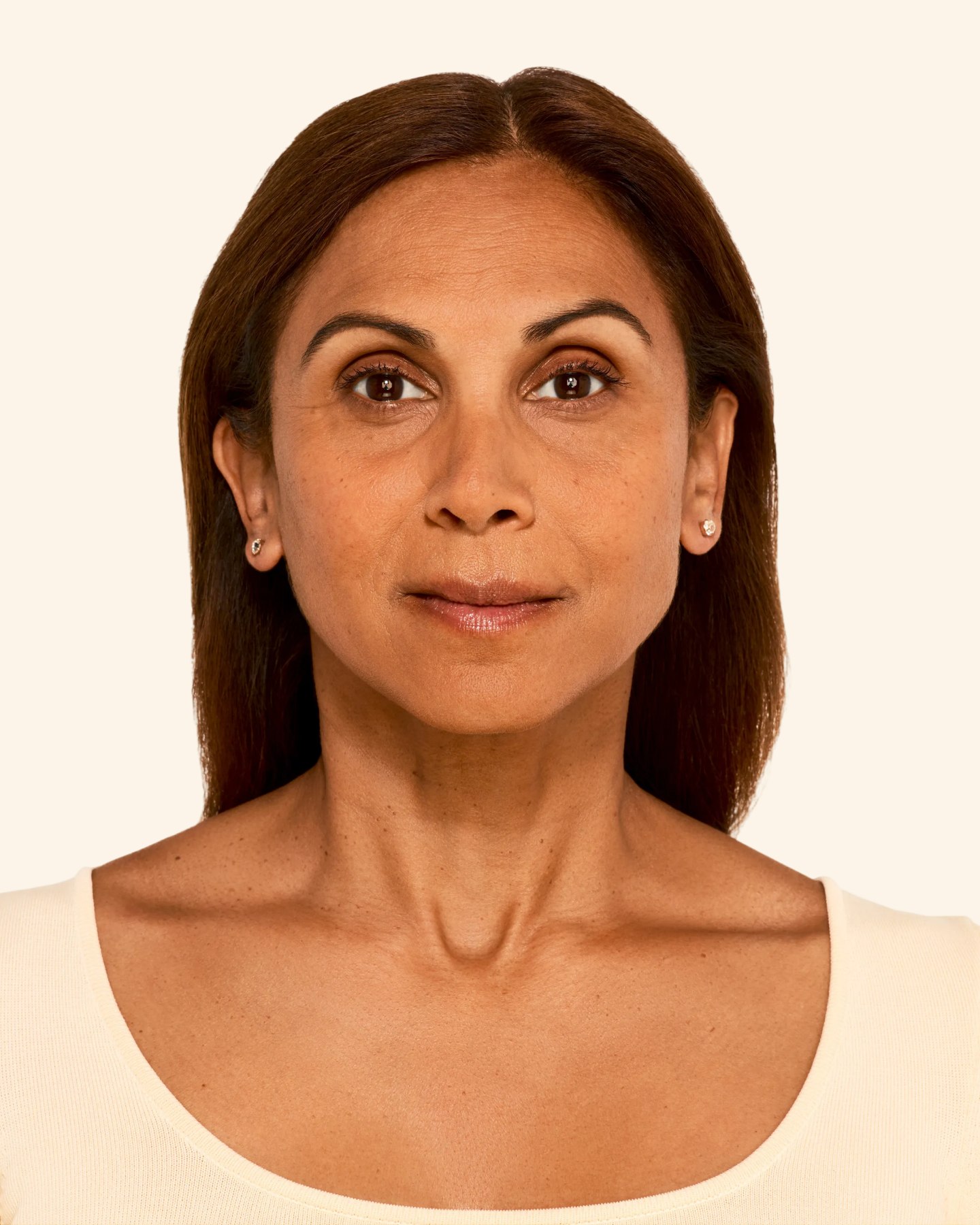 Aashna - Smile Lines Before Juvederm