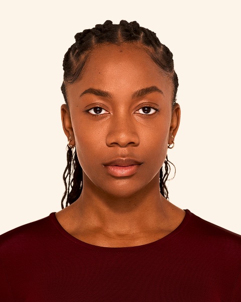 Jada - Chin After Juvederm