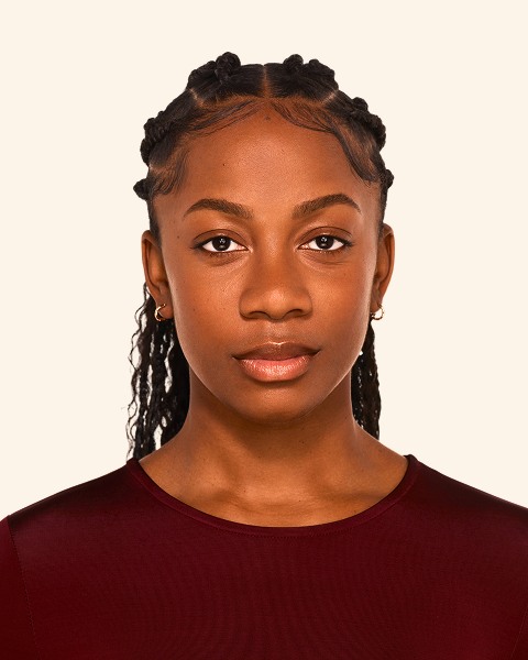 Jada - Chin Before Juvederm