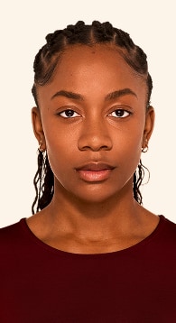 Jada - Chin After Juvederm