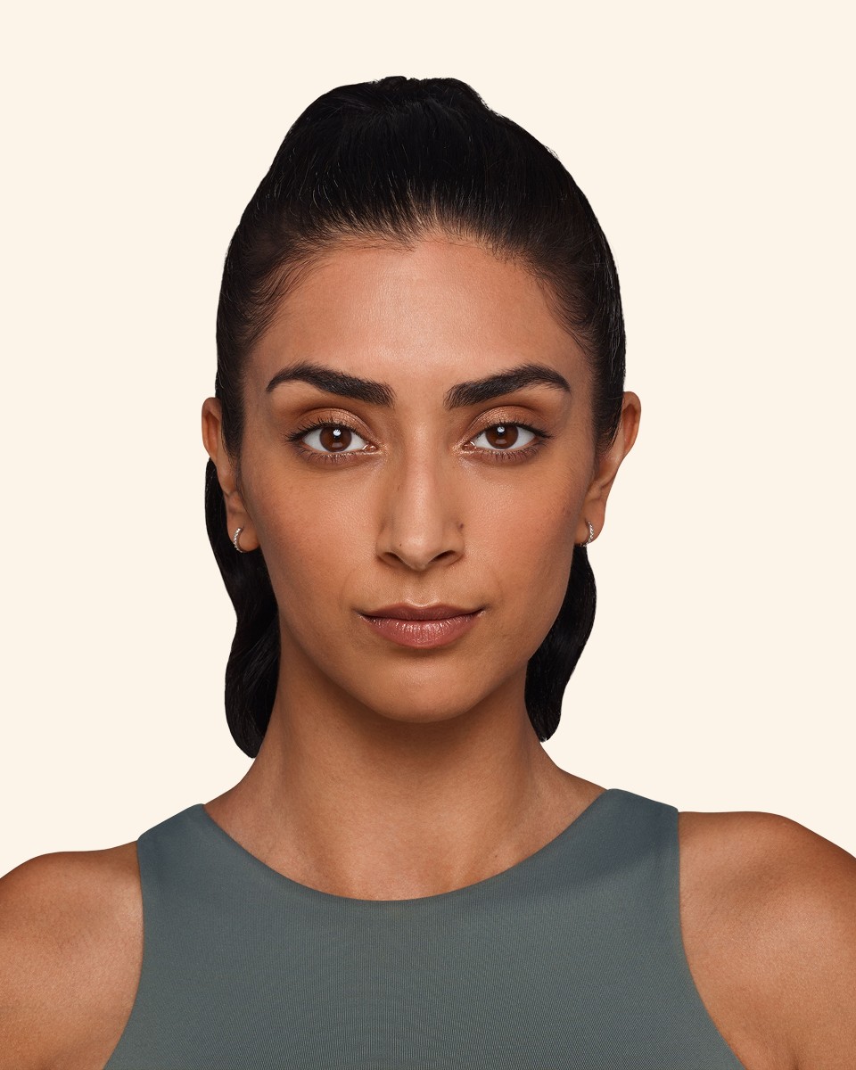 Jaskiran - Cheeks, chin, undereye, lines & lips Before Juvederm