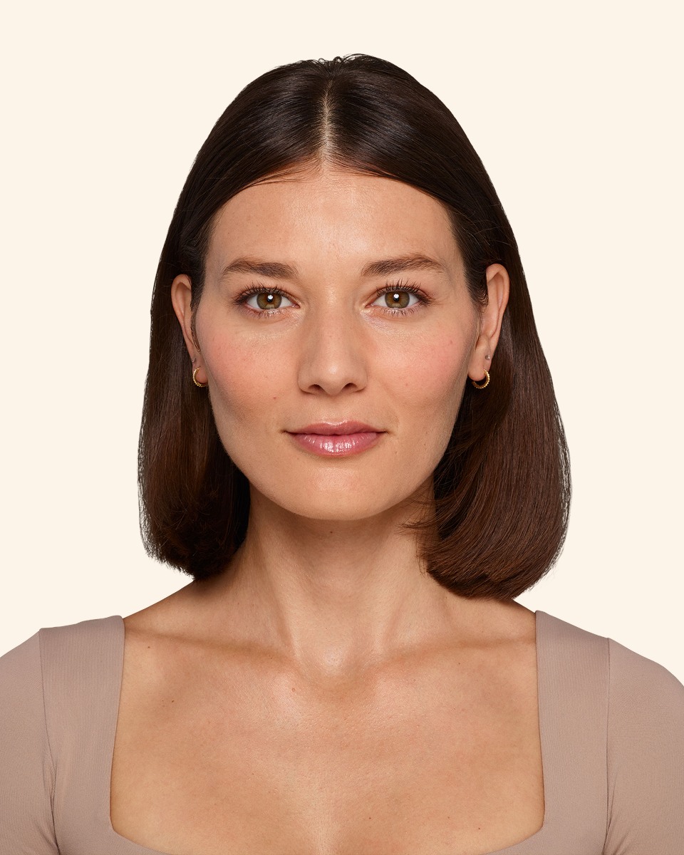 Victoria - After Under-eye Filler