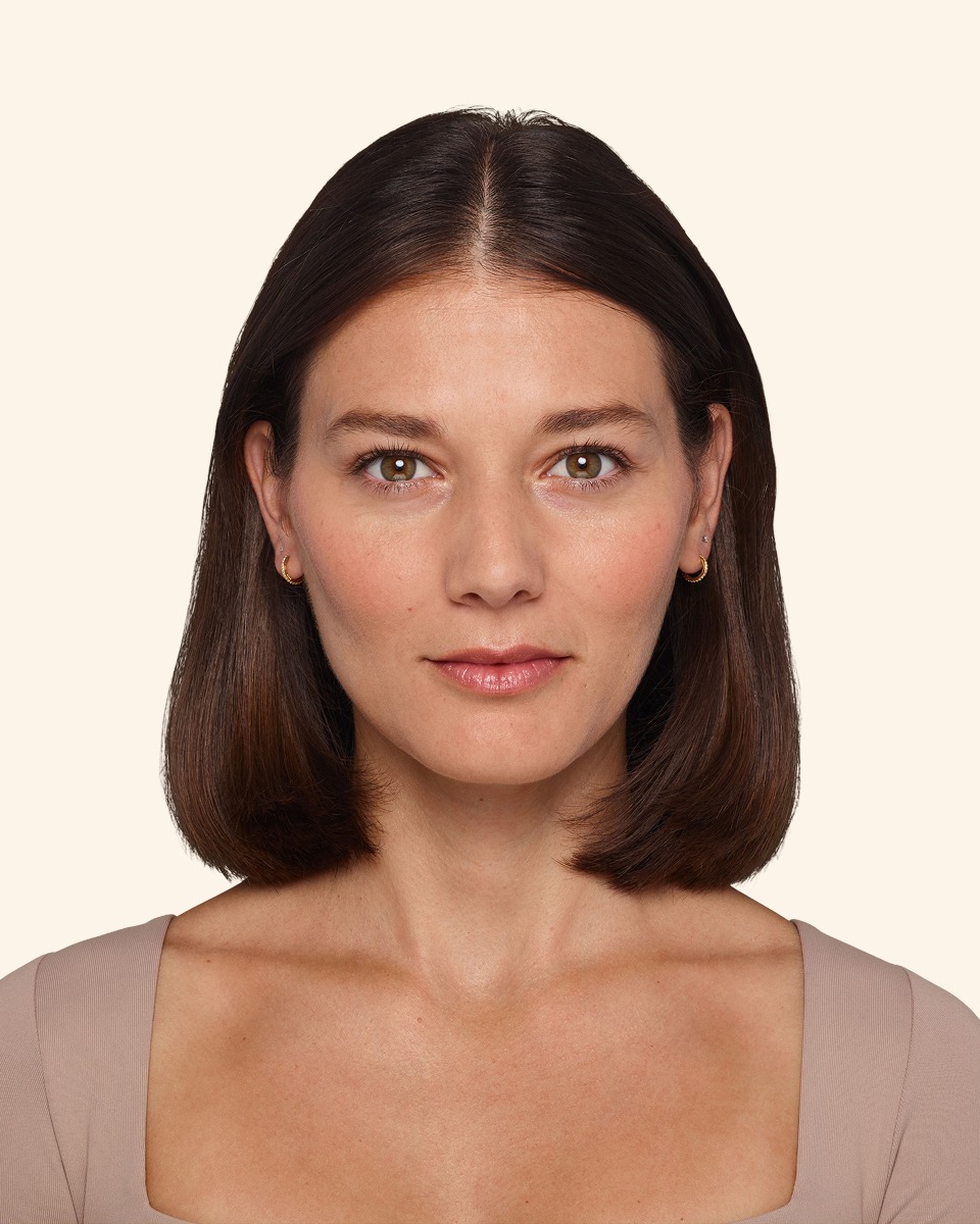 Victoria - Before Under-eye Filler