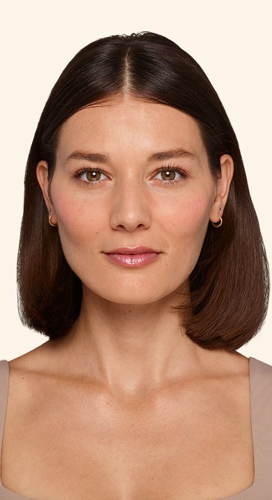 Victoria - After Under-eye Filler