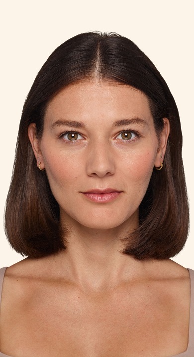 Victoria - Before Under-eye Filler